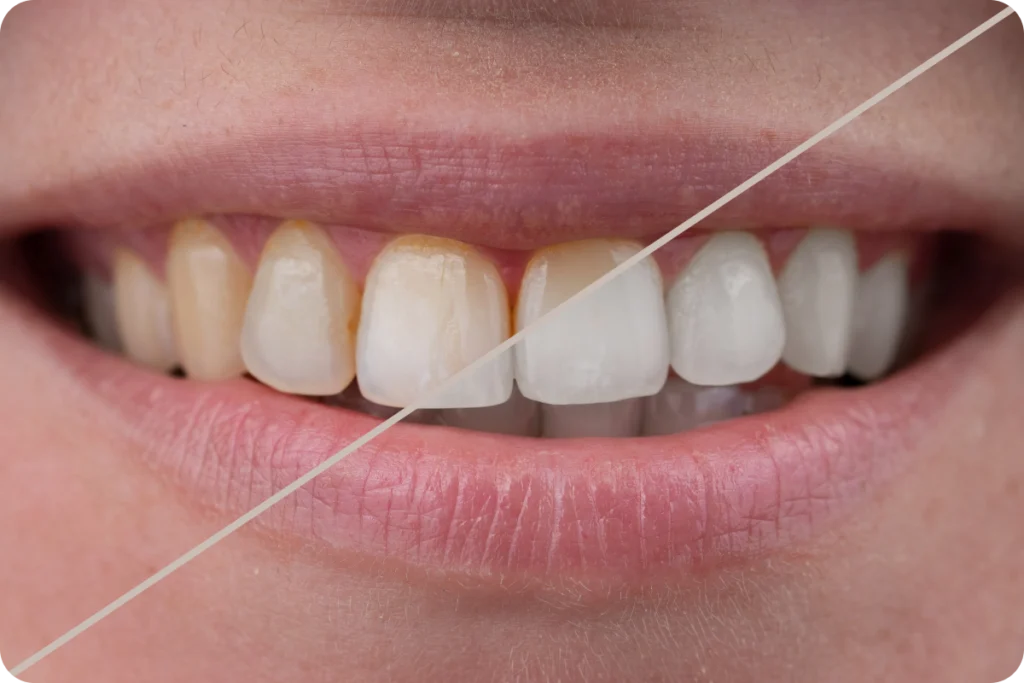 adobestock adobestock Blanchiment dentaire Dentistes et ophtalmologue à Saint-Ouen-sur-Seine