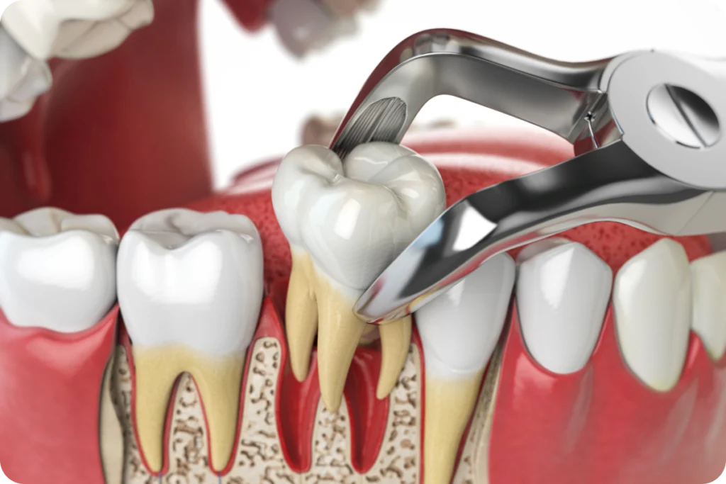 adobestock adobestock Quand extraire une dent ? Dentistes et ophtalmologue à Saint-Ouen-sur-Seine