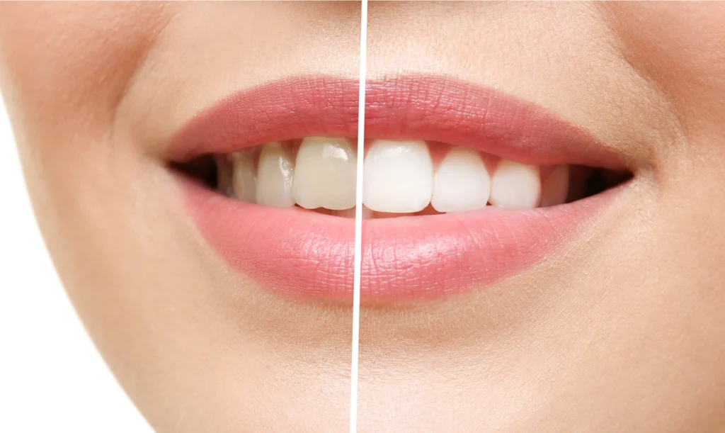 blanchiment eclaircissement dentaire paris Blanchiment dentaire Dentistes et ophtalmologue à Saint-Ouen-sur-Seine