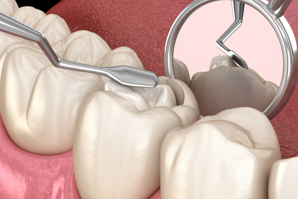 carie composite restauration paris Restaurations en composite (Plombage blanc) Dentistes et ophtalmologue à Saint-Ouen-sur-Seine