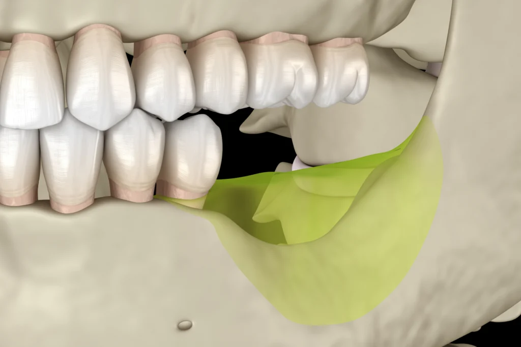 Quand extraire une dent ?