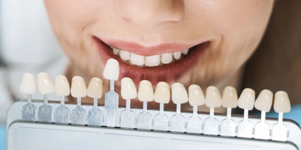 facettes dentaires veneers Facettes dentaires Dentistes et ophtalmologue à Saint-Ouen-sur-Seine