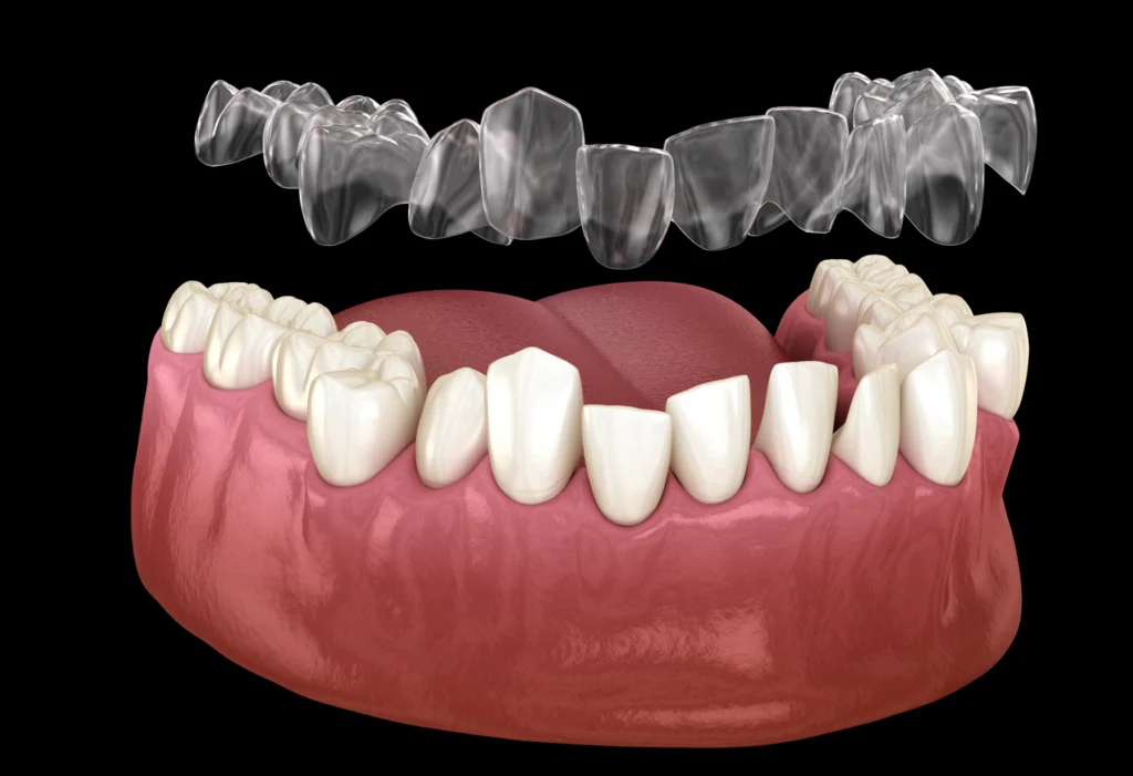 gouttieres aligneurs invisibles paris Gouttières d’alignement invisibles Dentistes et ophtalmologue à Saint-Ouen-sur-Seine