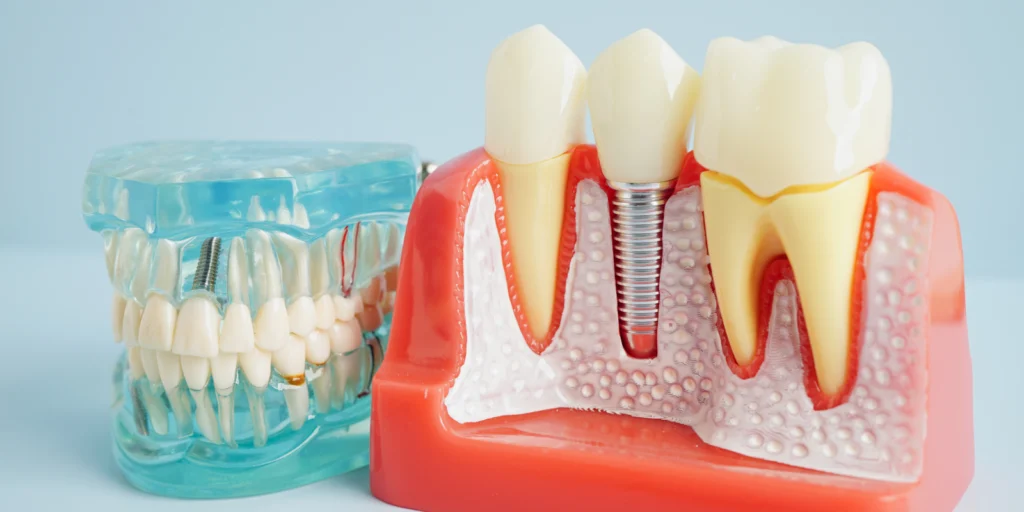 implant dentaire Implants dentaires Dentistes et ophtalmologue à Saint-Ouen-sur-Seine