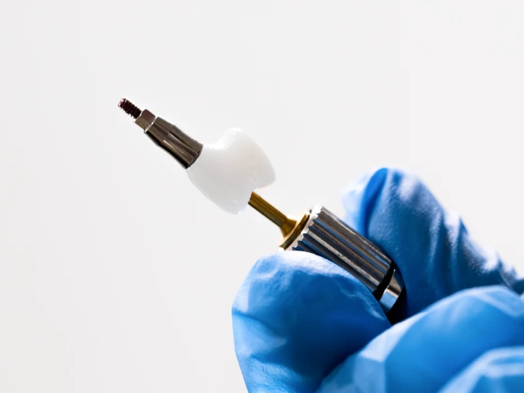 implant dentaire dent manquante Conseils pré-opératoires Dentistes et ophtalmologue à Saint-Ouen-sur-Seine