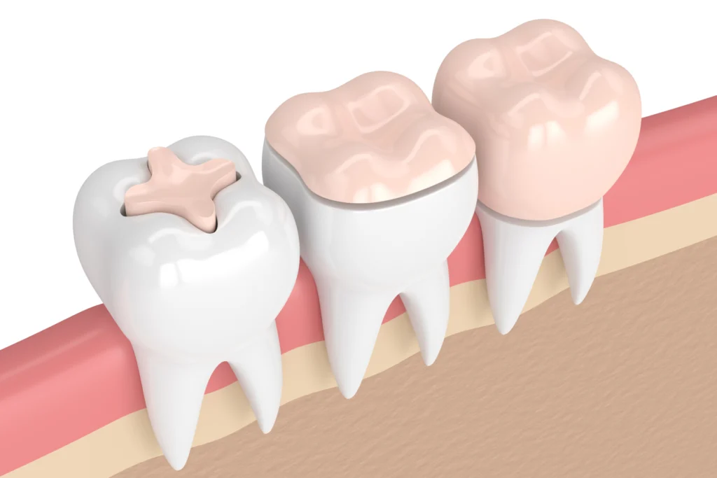 inlay onlay paris Restaurations en composite (Plombage blanc) Dentistes et ophtalmologue à Saint-Ouen-sur-Seine