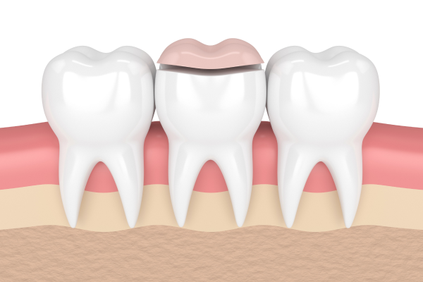 onlay soins conservateurs dentaire paris Soins dentaires esthétiques Dentistes et ophtalmologue à Saint-Ouen-sur-Seine
